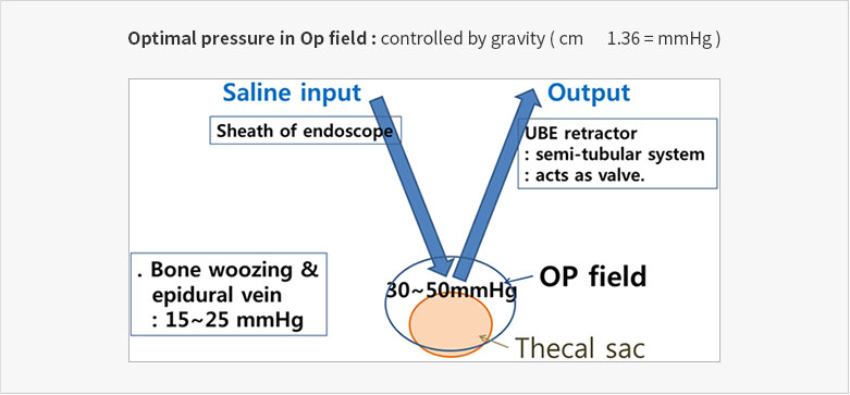Optimal pressure in Op field : controlled by gravity (cm1.36 = mmHg)